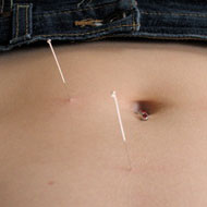 Acupuncture Therapy For Weight Loss