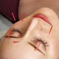 Acupuncture Face Lift Benefits