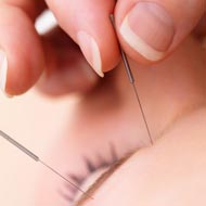 Acupuncture For Relieving Stress