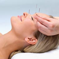Acupuncture For Migraine Relief